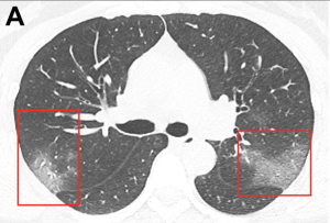 VIT Bhopal  - Best University in Central India -  coronavirus_CT_imaging_RSNA_Radiology-300x203